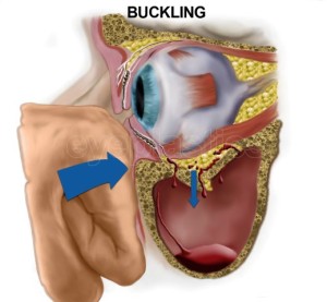 1393080231_buckling watermark (Small)