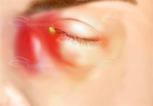 lacrimal-infection